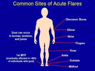 Gout - Clinical features , diagnosis and management | PPTX