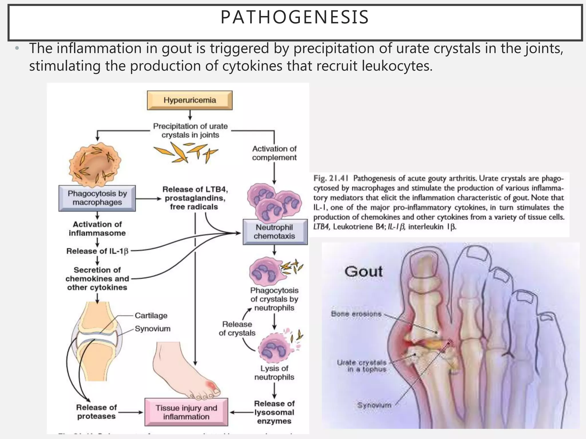 Pathophysiology Of Gout PPT pathophysiology-of-gout-ppt