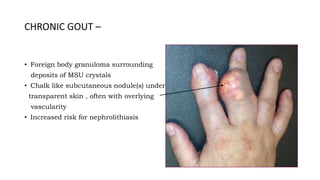 CHRONIC GOUT –
• Foreign body granuloma surrounding
deposits of MSU crystals
• Chalk like subcutaneous nodule(s) under
transparent skin , often with overlying
vascularity
• Increased risk for nephrolithiasis
 