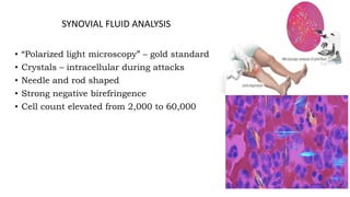 SYNOVIAL FLUID ANALYSIS
• “Polarized light microscopy” – gold standard
• Crystals – intracellular during attacks
• Needle and rod shaped
• Strong negative birefringence
• Cell count elevated from 2,000 to 60,000
 