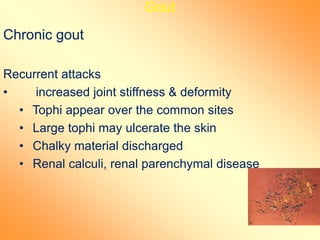 Gout
Chronic gout
Recurrent attacks
• increased joint stiffness & deformity
• Tophi appear over the common sites
• Large tophi may ulcerate the skin
• Chalky material discharged
• Renal calculi, renal parenchymal disease
 