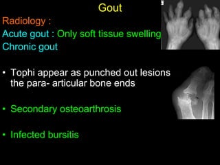 Gout
Radiology :
Acute gout : Only soft tissue swelling
Chronic gout
• Tophi appear as punched out lesions (cysts) in
the para- articular bone ends
• Secondary osteoarthrosis
• Infected bursitis
 