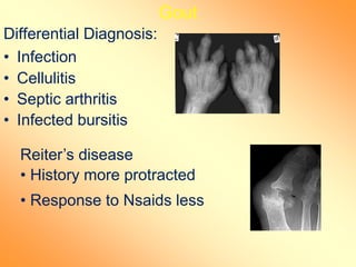 Gout
Differential Diagnosis:
• Infection
• Cellulitis
• Septic arthritis
• Infected bursitis
Reiter’s disease
• History more protracted
• Response to Nsaids less
 