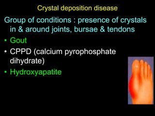 Crystal deposition disease
Group of conditions : presence of crystals
in & around joints, bursae & tendons
• Gout
• CPPD (calcium pyrophosphate
dihydrate)
• Hydroxyapatite
 