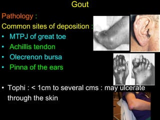 Pathology :
Common sites of deposition :
• MTPJ of great toe
• Achillis tendon
• Olecrenon bursa
• Pinna of the ears
• Tophi : < 1cm to several cms : may ulcerate
through the skin
Gout
 
