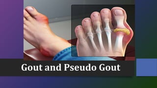 Gout and Pseudo Gout
 