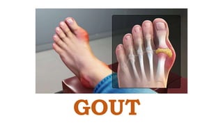 GOUT
 