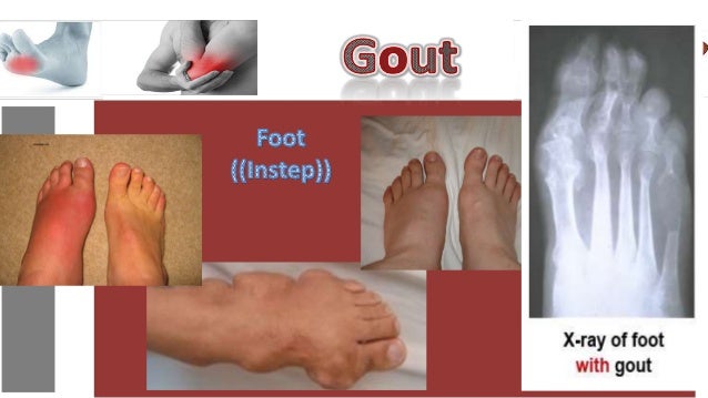 Gout