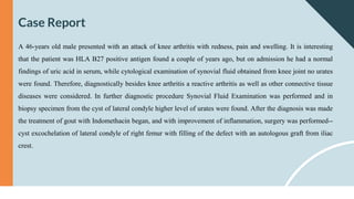 Case Report
A 46-years old male presented with an attack of knee arthritis with redness, pain and swelling. It is interesting
that the patient was HLA B27 positive antigen found a couple of years ago, but on admission he had a normal
findings of uric acid in serum, while cytological examination of synovial fluid obtained from knee joint no urates
were found. Therefore, diagnostically besides knee arthritis a reactive arthritis as well as other connective tissue
diseases were considered. In further diagnostic procedure Synovial Fluid Examination was performed and in
biopsy specimen from the cyst of lateral condyle higher level of urates were found. After the diagnosis was made
the treatment of gout with Indomethacin began, and with improvement of inflammation, surgery was performed--
cyst excochelation of lateral condyle of right femur with filling of the defect with an autologous graft from iliac
crest.
 