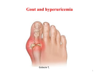 Gout and hyperuricemia
1
Gobezie T,
 