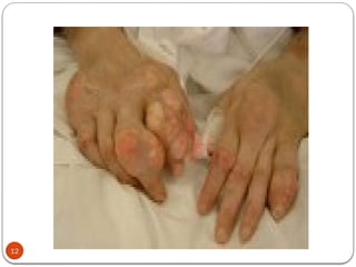 NOTES ON GOUT ARTHRITIS AND INFLAMMATORY JOINT DISORDERS. | PPTX
