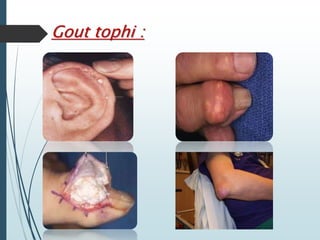 Gout tophi : 
 