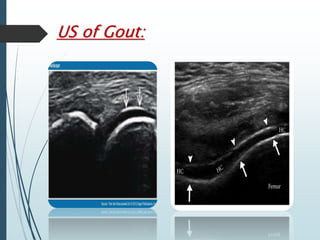 US of Gout: 
 