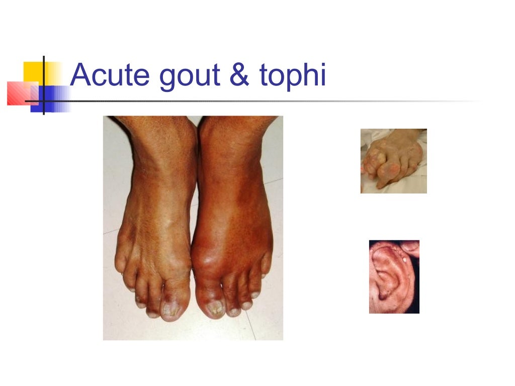 Gout & osteoarthritis