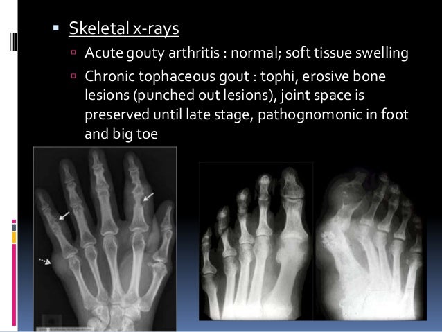 Gout presentation