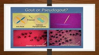 Gout pseudogout