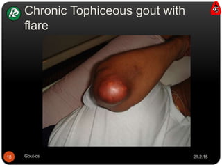 Chronic Tophiceous gout with
flare
21.2.1518 Gout-cs
 