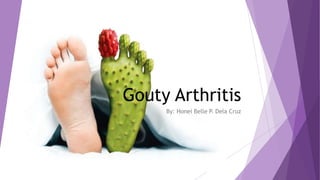 Gouty Arthritis
By: Honei Belle P. Dela Cruz
 