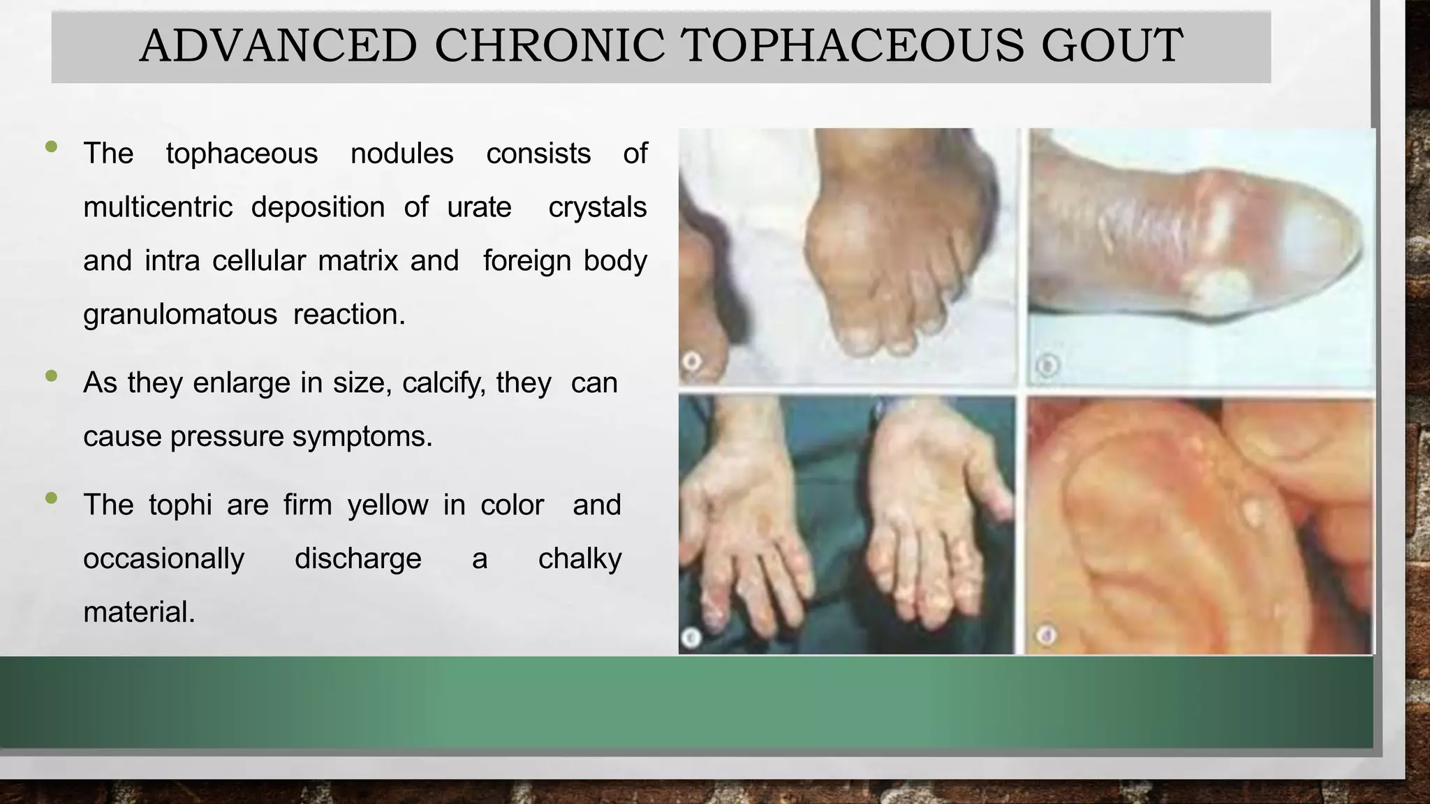 Gouty Arthritis PPTX