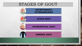 STAGES OF GOUT
ASYMPTOMATIC
HYPERURECEMIA
ACUTE GOUT
INTERCRITICAL GOUT
CHRONIC GOUT
 