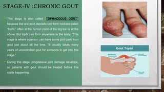 STAGE-IV :CHRONIC GOUT
• This stage is also called “TOPHACEOUS GOUT”
because the uric acid deposits can form nodules called
“tophi,” often at the bunion point of the big toe or at the
elbow. But tophi can form anywhere in the body. “This
stage is where a person can have some joint pain from
gout just about all the time. “It usually takes many
years of uncontrolled gout for someone to get into this
stage.”
• During this stage, progressive joint damage develops,
so patients with gout should be treated before this
starts happening.
 