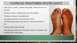 CLINICAL FEATURES-ACUTE GOUT
• Acute gout is a painful condition that typically affects only one or a
few joints.
• The big toe, knee, or ankle joints are most often affected.
• Throbbing, crushing, or excruciating pain
• Joint appears warm and red. Fever may be there.
• The attack may go away in a few days, but may return from time to
time.
• Additional attacks often last longer.
• After a first gouty attack, half of the people will have no symptoms. Half
of patients have another attack.
 