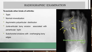 RADIOGRAPHIC EXAMINATION
To exclude other kinds of arthritis:
• Tophi
• Normal mineralization
• Asymmetric polyarticular distribution
• Juxta-articular bony erosion associated with
periarticular tophi
• Subchondral erosions with overhanging bony
edges
 