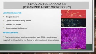 SYNOVIAL FLUID ANALYSIS
(POLARIZED LIGHT MICROSCOPY)
JOINT FLUID ANALYSIS:
• The gold standard
• Crystals intracellular during attacks
• Needle & rod shapes
• Strong negative birefringence
ARTHROCENTESIS
• Polarizing microscopy showing monosodium urate (MSU) : needle-shaped
negatively birefringent either free floating or within neutrophils & macrophages.
 