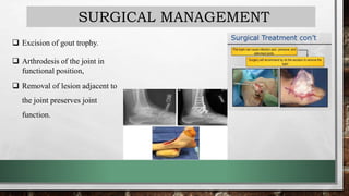 SURGICAL MANAGEMENT
 Excision of gout trophy.
 Arthrodesis of the joint in
functional position,
 Removal of lesion adjacent to
the joint preserves joint
function.
 