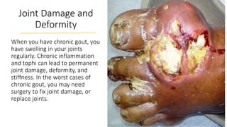 Joint Damage and
Deformity
When you have chronic gout, you
have swelling in your joints
regularly. Chronic inflammation
and tophi can lead to permanent
joint damage, deformity, and
stiffness. In the worst cases of
chronic gout, you may need
surgery to fix joint damage, or
replace joints.
 