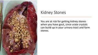 Kidney Stones
You are at risk for getting kidney stones
when you have gout, since urate crystals
can build up in your urinary tract and form
stones.
 