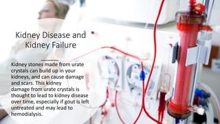 Kidney Disease and
Kidney Failure
Kidney stones made from urate
crystals can build up in your
kidneys, and can cause damage
and scars. This kidney
damage from urate crystals is
thought to lead to kidney disease
over time, especially if gout is left
untreated and may lead to
hemodialysis.
 