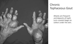 Chronic
Tophaceous Gout
Attacks are frequent
and deposits of tophi
(uric crystals) begin to
collect under the skin.
 