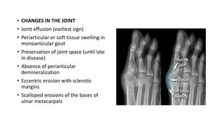 Gout Racgp Gout | PPTX