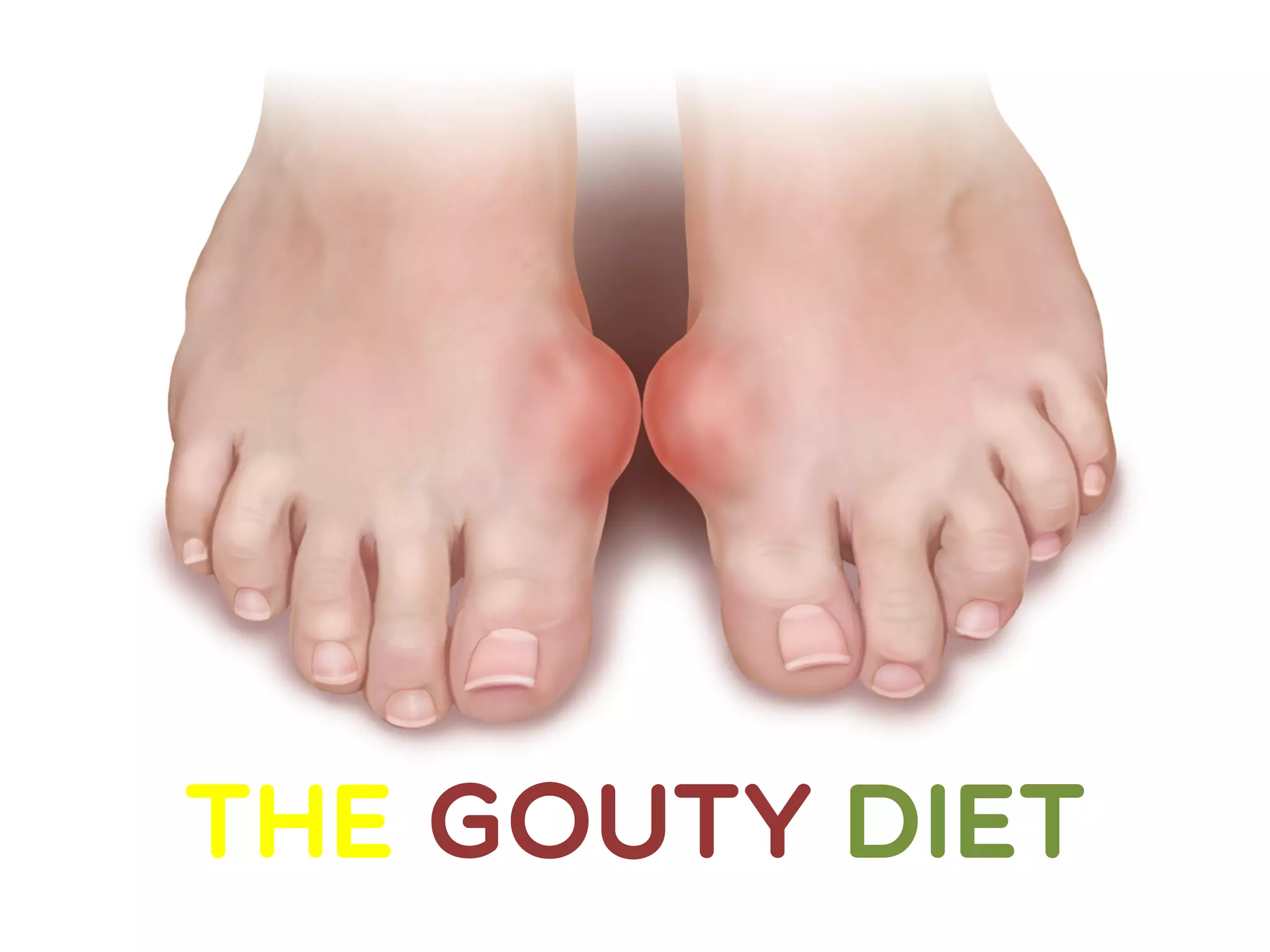 The Gouty Arthritis Diet PPT