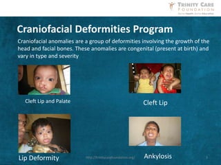 Craniofacial anomalies are a group of deformities involving the growth of the
head and facial bones. These anomalies are congenital (present at birth) and
vary in type and severity
Cleft Lip and Palate
Craniofacial Deformities Program
Lip Deformity
Cleft Lip
Ankylosis 3http://trinitycarefoundation.org/
 