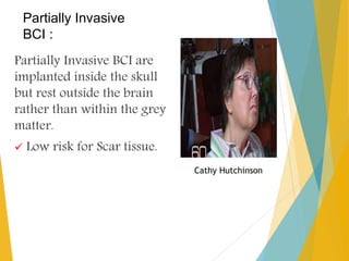 Partially Invasive
BCI :
Partially Invasive BCI are
implanted inside the skull
but rest outside the brain
rather than within the grey
matter.
 Low risk for Scar tissue.
Cathy Hutchinson
 