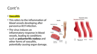 Cont’n
• Vasculitis
• This refers to the inflammation of
blood vessels developing after
parvovirus B19 infection.
• The virus induces an
inflammatory response in blood
vessels, leading to conditions
such as polyarteritis nodosa and
other forms of vasculitis,
potentially causing organ damage.
 