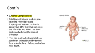 Cont’n
• 3. Other Complications
• Fetal Complications such as non
immune Hydrops Fetalis
If a pregnant woman contracts
parvovirus B19, the virus can cross
the placenta and infect the fetus,
particularly during the second
trimester.
• This can lead to hydrops fetalis, a
condition characterized by severe
fetal anemia, heart failure, and often
fetal death.
 