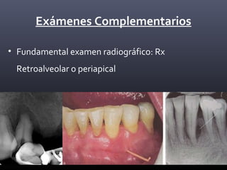 Exámenes Complementarios
• Fundamental examen radiográfico: Rx
Retroalveolar o periapical
 