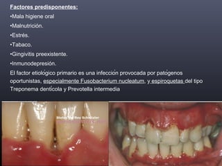 Factores predisponentes:
•Mala higiene oral
•Malnutrición.
•Estrés.
•Tabaco.
•Gingivitis preexistente.
•Inmunodepresión.
El factor etiológico primario es una infección provocada por patógenos
oportunistas, especialmente Fusobacterium nucleatum, y espiroquetas del tipo
Treponema dentícola y Prevotella intermedia
 