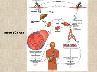 BỆNH SỐT RÉT
 