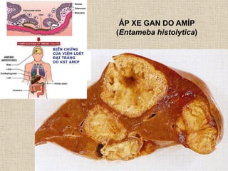 ÁP XE GAN DO AMÍP
(Entameba histolytica)
 