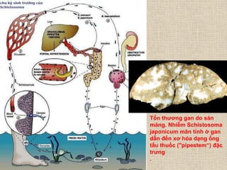 Tổn thƣơng gan do sán
máng. Nhiễm Schistosoma
japonicum mãn tính ở gan
dẫn đến xơ hóa dạng ống
tẩu thuốc ("pipestem“) đặc
trƣng
.
 
