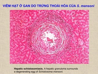 Hepatic schistosomiasis. A hepatic granuloma surrounds
a degenerating egg of Schistosoma mansoni.
VIÊM HẠT Ở GAN DO TRỨNG THOÁI HÓA CỦA S. mansoni
 