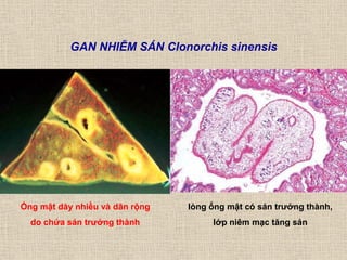 GAN NHIỄM SÁN Clonorchis sinensis
lòng ống mật có sán trƣởng thành,
lớp niêm mạc tăng sản
Ống mật dày nhiều và dãn rộng
do chứa sán trƣởng thành
 