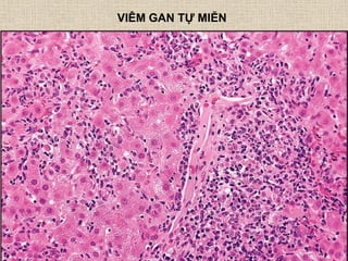 VIÊM GAN TỰ MIỄN
 