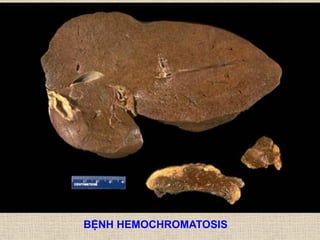BỆNH HEMOCHROMATOSIS
 