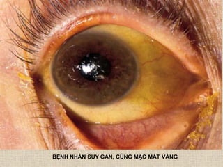 BỆNH NHÂN SUY GAN, CỦNG MẠC MẮT VÀNG
 