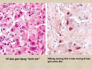Teá baøo gan daïng "kính môø" HBsAg dƣơng tính ở bào tƣơng tế bào
gan (màu đỏ).
 
